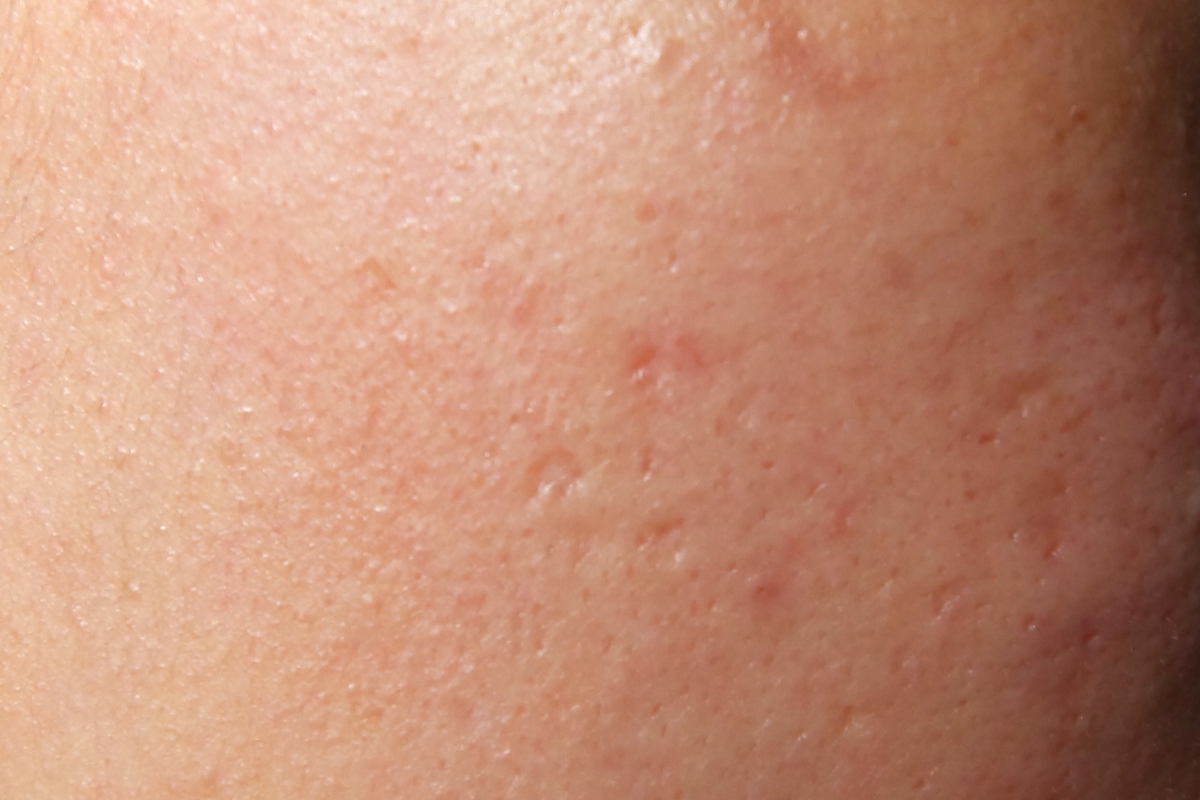 Skincare estiva: cosa succede alla pelle in estate
