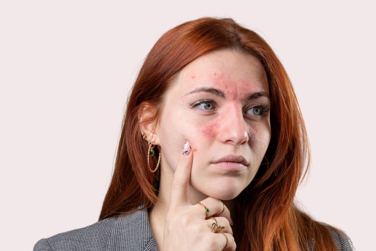 detergente delicato per couperose e dermatite