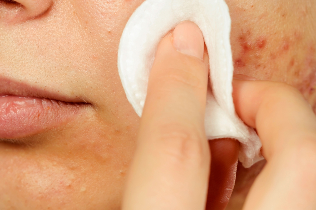 limone sul viso come, quanto e quante volte applicarlo