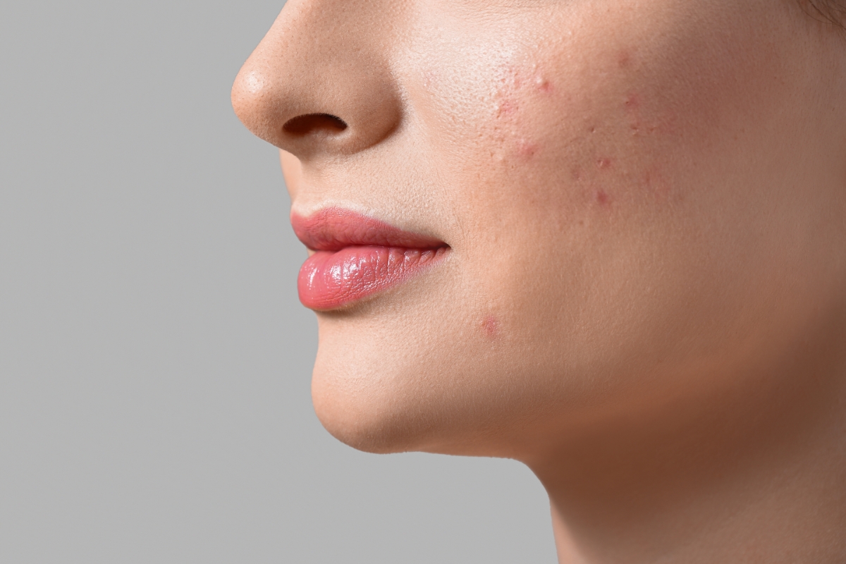 Acidi nella skincare, cosa fanno?