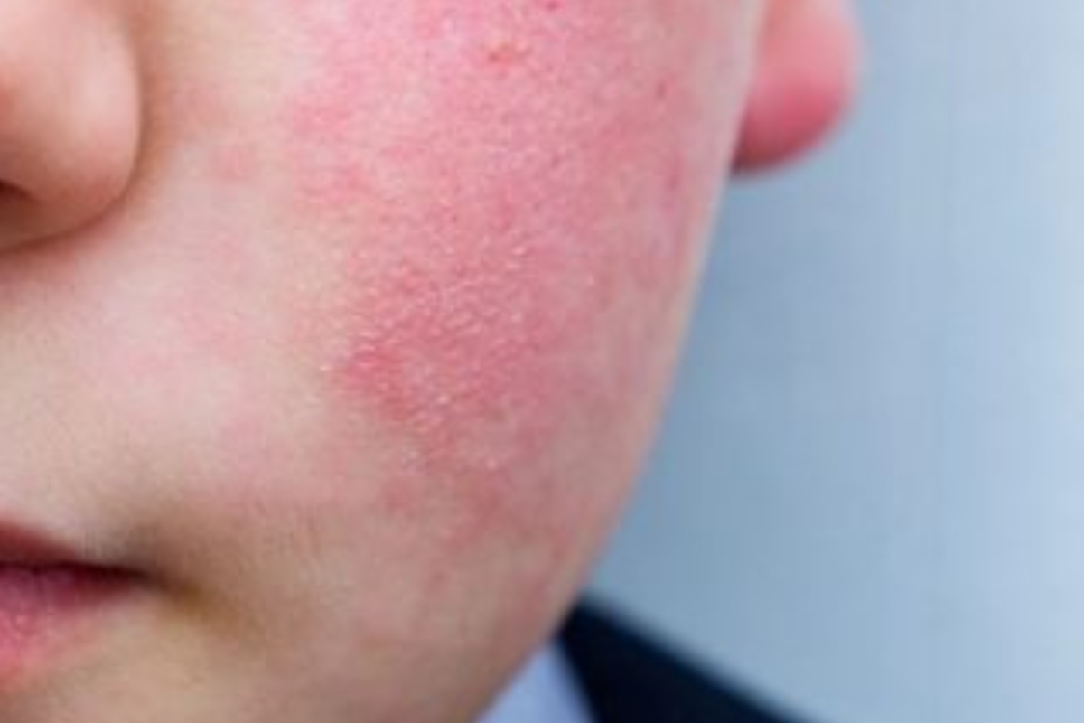 Dermatite Da Sudore Della Pelle O Sudamina